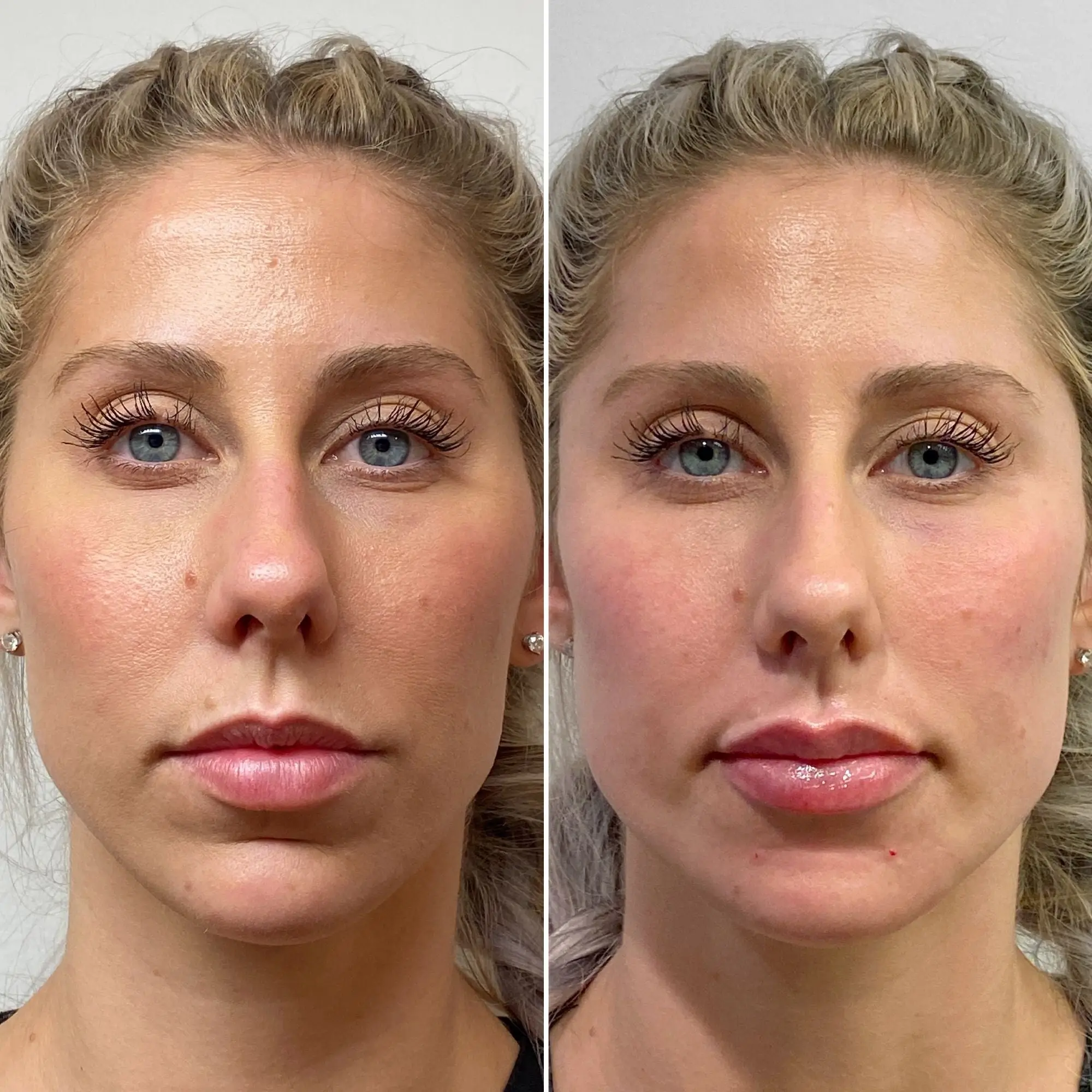 FaceFix_Sculptra3