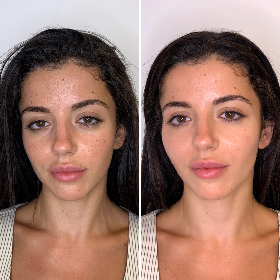 Fillers_restylane_BA_Image_10x