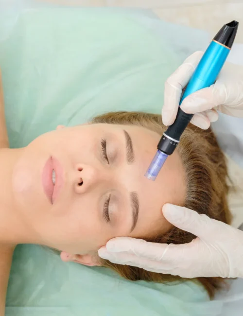 microneedling_1